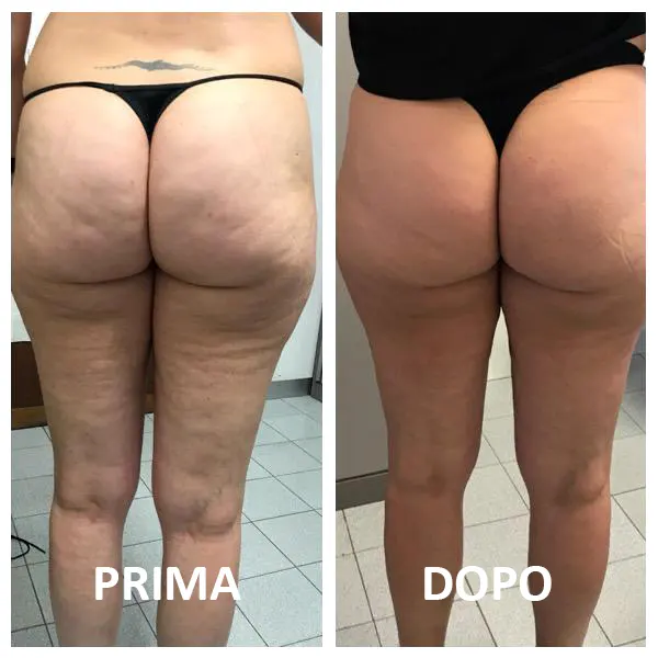 Dimagrimento Natiche Sedere Dottoressa Milena Massari